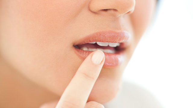 COLD SORES, AKA FEVER BLISTERS